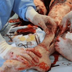 Lower Limb Fasciotomy