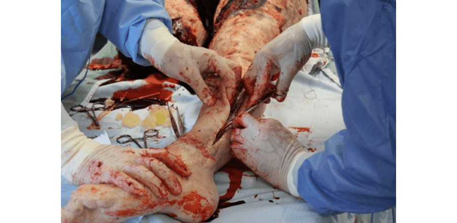 Lower Limb Fasciotomy