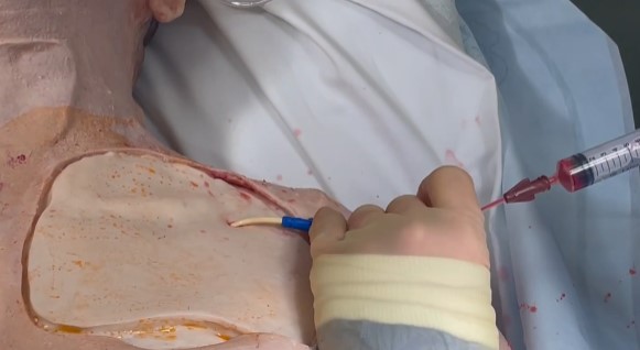 Replaceable Resuscitation Inserts for SAM 1.4 MK V