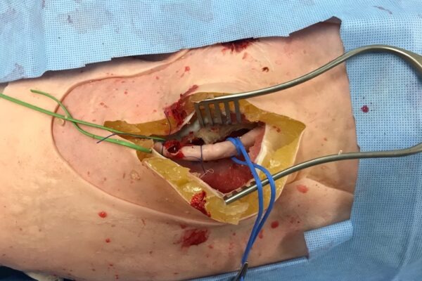 Replaceable Surgical Inserts for SAM 1.4 MK VI